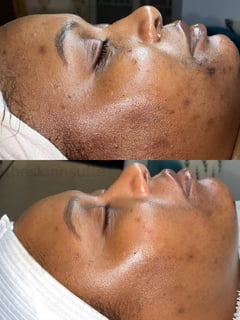 View Skin Treatments, Facial, Chemical Peel, Dermaplaning, Skin Treatments - Liana JnoRose, Brooklyn, NY