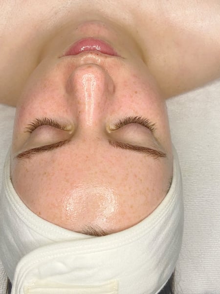 Image of  Cosmetic, Facial, Skin Treatments, Chemical Peel