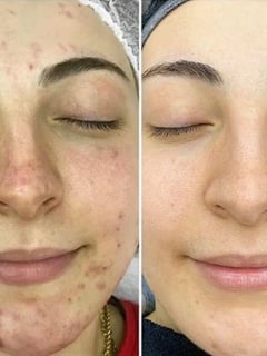 View Cosmetic, Skin Treatments, Facial - Amy Meccariello, Las Vegas, NV