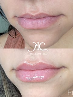 View Lips, Cosmetic, Filler - Karla Cabrera, FNP-C, Tempe, AZ