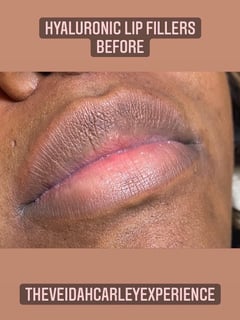 View Lips, Filler, Cosmetic - Saidah Crawford, Rochester, NY
