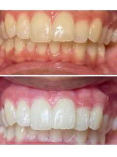 View Teeth Whitening, Cosmetic - Sharelle Castro, Mililani, HI