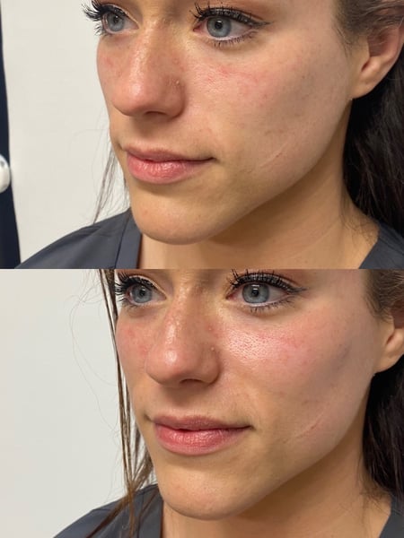 Image of  Cheeks, Filler, Cosmetic