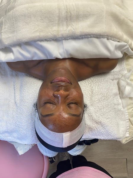 Image of  Microdermabrasion, Skin Treatments, Facial