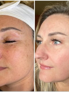 View Skin Treatments, Facial, Chemical Peel, Microdermabrasion, Microneedling, LED Acne Therapy, Dermaplaning, HydraFacial, Skin Treatments - Alder Orme, Meridian, ID