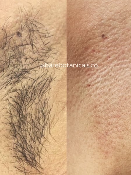 Image of  Cosmetic, Waxing, Skin Treatments, Underarms 