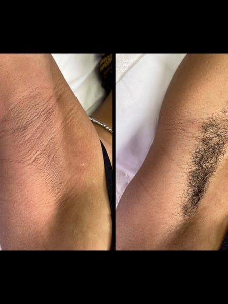Image of  Waxing, Underarms , Hair Removal