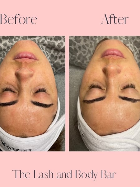 Image of  Cosmetic, Skin Treatments, Chemical Peel