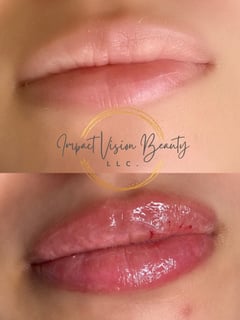View Cosmetic, Lips, Filler - Thelma Rose, Vallejo, CA