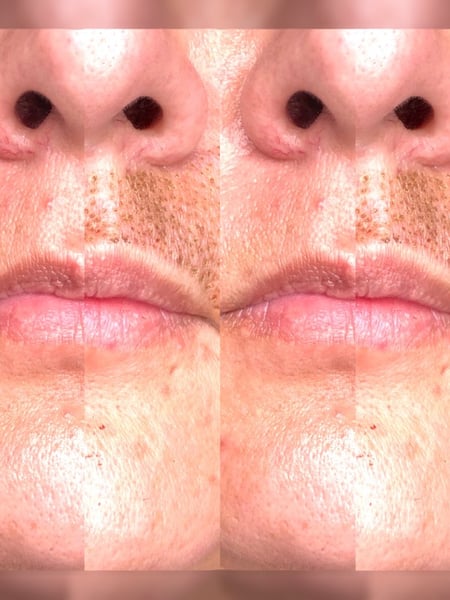 Image of  Cosmetic, Mini Facelift, Minimally Invasive, Filler, Lips, Skin Treatments