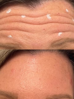View Cosmetic, Neurotoxin, Upper Face - Katelyn Burke, Windham, NH