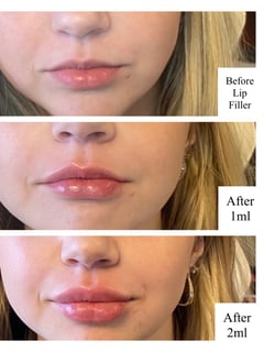 View Nose, Lower Face, Eyes, Upper Face, Neurotoxin, Cosmetic, Nasolabial Folds (Smile Lines), Cheek , Lips, Filler, Chin, Forehead - Brittanee Perez, Tulsa, OK