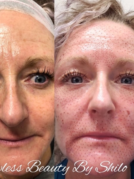 Image of  Cosmetic, Minimally Invasive, Mini Facelift, Skin Treatments