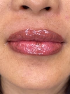 View Cosmetic, Lips, Filler - Theresa Nguyen, San Diego, CA