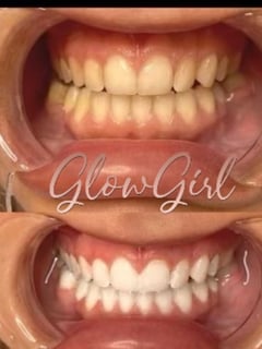 View Cosmetic, Teeth Whitening - Rebecca Matthews, Bakersfield, CA