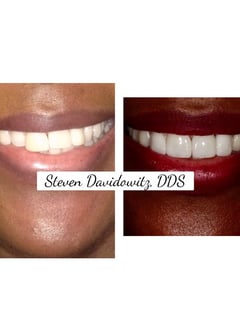 View Dentistry Services, Dentistry, Porcelain Veneers - Dr. Steven Davidowitz, New York, NY