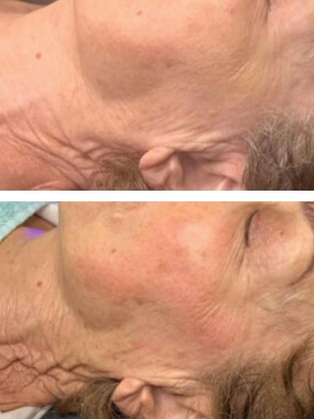Image of  Cosmetic, Mini Facelift, Minimally Invasive, Neck Tightening, Skin Treatments, Facial, Chemical Peel