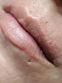 View Lips, Filler, Cosmetic - Glenn Gustafik, Concord, CA