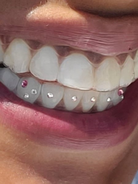 Image of  Cosmetic, Teeth Whitening, Dentistry, Teeth Bleaching