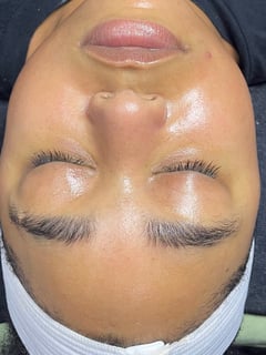 View Skin Treatments, Facial, LED Acne Therapy, Dermaplaning, HydraFacial, Skin Treatments - Chrislyn T, Pico Rivera, CA