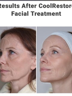 View Cosmetic, Mini Facelift, Minimally Invasive, Neck Tightening, Facial, Skin Treatments - Shilo Hope Stanley, La Mesa, CA