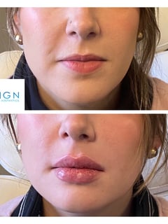 View Forehead, Lower Face, Eyes, Upper Face, Neurotoxin, Cosmetic, Nasolabial Folds (Smile Lines), Cheek , Lips, Filler, Chin, Nose - Brittanee Perez, Tulsa, OK