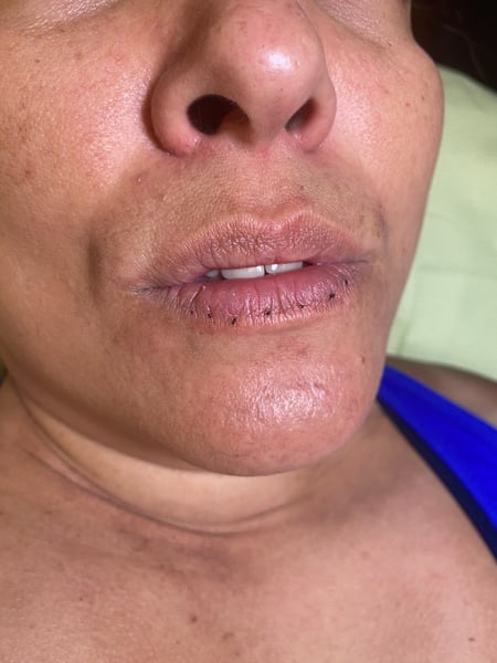 Image of  Lips, Filler, Cosmetic