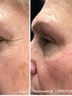 View Cosmetic, Minimally Invasive, Skin Treatments, Facial - Julia Wedge Schoenwandt, Fair Oaks, CA