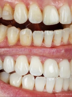 View Teeth Whitening, Dentistry, Teeth Bleaching, Dental Bonding, Porcelain Veneers, Dentistry Services - Dr. Catharine Song, Beverly Hills, CA
