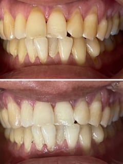 View Cosmetic, Teeth Whitening - Sharelle Castro, Mililani, HI