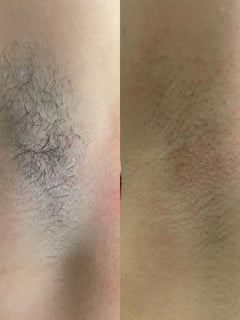 View Hair Removal, Waxing, Underarms  - Shyann S, Fresno, CA