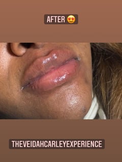 View Lips, Cosmetic, Filler - Saidah Crawford, Rochester, NY