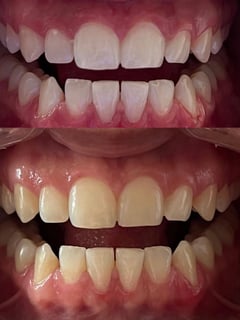 View Teeth Whitening, Teeth Bleaching, Dentistry, Dentistry Services - Carolina Guillermo, New York, NY