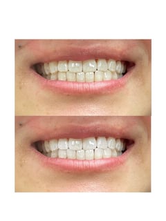 View Teeth Whitening, Cosmetic - Treasure G., Yonkers, NY