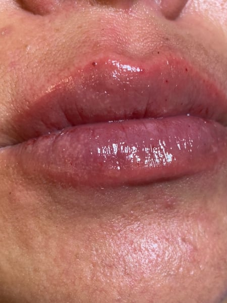 Image of  Lips, Filler, Cosmetic