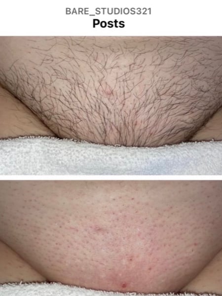 Image of  Waxing, Hair Removal