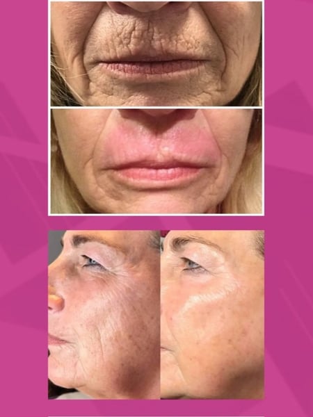Image of  Cosmetic, Mini Facelift, Minimally Invasive, Neck Tightening, Microdermabrasion, Skin Treatments