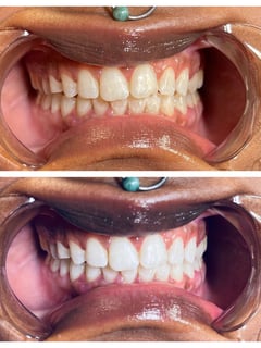 View Cosmetic, Teeth Whitening - Yetta B., Orlando, FL