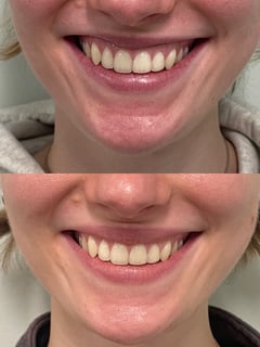 View Cosmetic, Neurotoxin, Lower Face - Katelyn Burke, Windham, NH