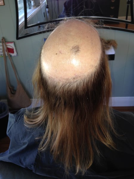 Image of  Hair Restoration, Women's Hair