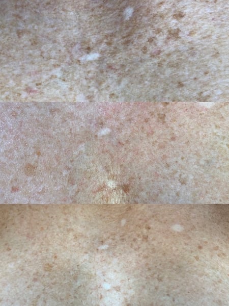 Image of  Cosmetic, Skin Treatments, Chemical Peel