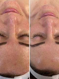 View Skin Treatments, Facial, Chemical Peel - Tatyana Fedoruk, Arlington, WA