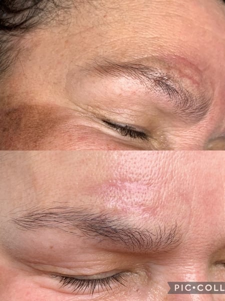 Image of  Cosmetic, Minimally Invasive, Skin Treatments, Facial, Microdermabrasion, Chemical Peel
