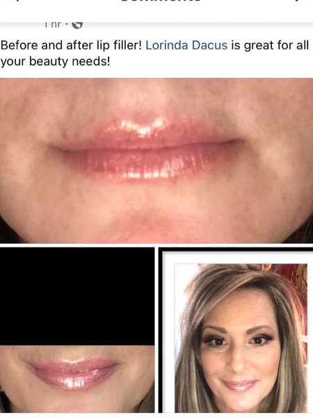 Image of  Cosmetic, Lips, Filler, Neurotoxin