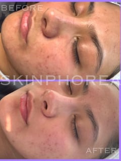 View Chemical Peel, Skin Treatments, Waxing, Microdermabrasion, Cosmetic, Facial - Brielle Hicks, Detroit, MI