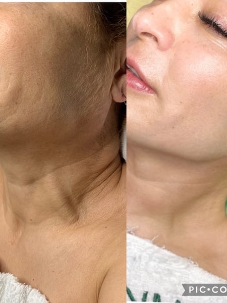 Image of  Cosmetic, Minimally Invasive, Mini Facelift, Neck Tightening, Skin Treatments, Facial, Microdermabrasion, Chemical Peel