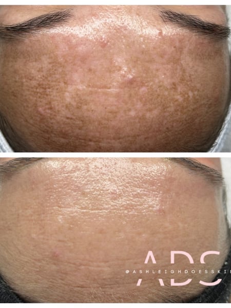 Image of  Skin Treatments, Chemical Peel, LED Acne Therapy, Dermaplaning, Skin Treatments