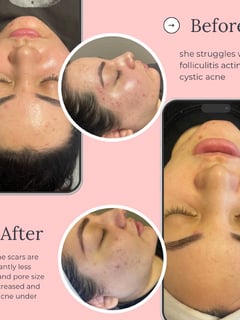 View Microneedling, LED Acne Therapy, Dermaplaning, Skin Treatments, Skin Treatments, Facial, Chemical Peel, Microdermabrasion - Lisa Junior, Las Vegas, NV