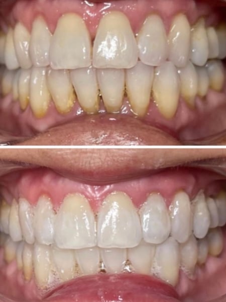 Image of  Cosmetic, Teeth Whitening