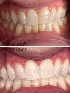 View Teeth Whitening, Cosmetic - Jenn Hooker, Kingwood, TX
